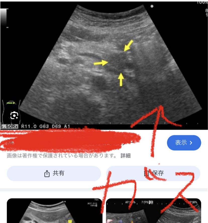 $メインズ バイオメッド NV (MYNZ.US)$ これがBOTだらけの銘柄か。膵臓ガンを便検査で見つけられたらすごいぞ。 自覚症状にとぼしく、エコーでも見つけにくいので、、、 そもそもガスってたりすると膵臓は見つけにくいのです。 エコー写真をご覧ください。 サーってなってるのがガス。　 あれが全体的にあると膵臓が見...